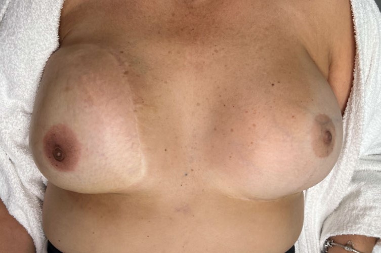 Areola reconstruction Micropigmentation by Oneline Beauty Clinic